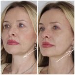Résultats avant/après lifting du visage à Altos Clinic, amélioration du menton et du cou