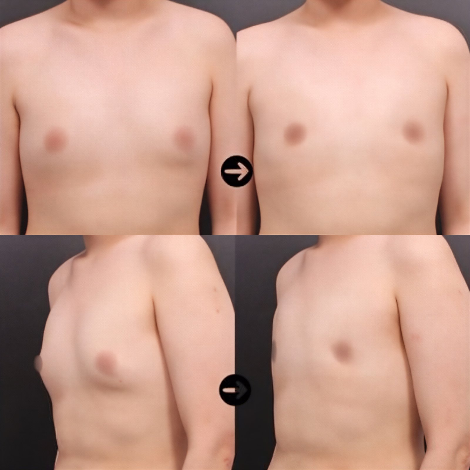 نتائج قبل وبعد جراحة التثدي في VG Plastic Surgery، تحسين شكل الصدر