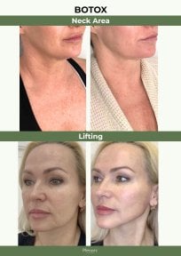 Before and after Botox neck and face lifting results at Plenary Wellness, visible skin tightening