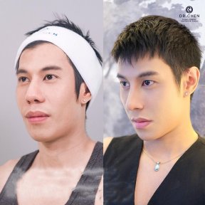 Before and after revision rhinoplasty results at Dr. Chen Surgery Hospital International Center