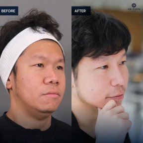 Before and after revision rhinoplasty results at Dr. Chen Surgery Hospital International Center