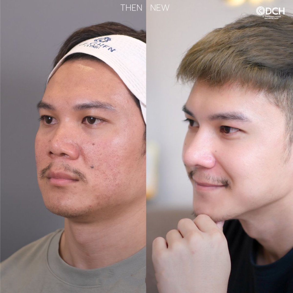 Resultados de rinoplastia de revisión antes y después en Dr. Chen Surgery Hospital International Center