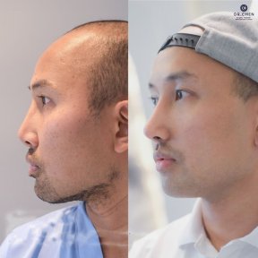 Before and after revision rhinoplasty result at Dr. Chen Surgery Hospital International Center