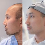 Before and after revision rhinoplasty result at Dr. Chen Surgery Hospital International Center