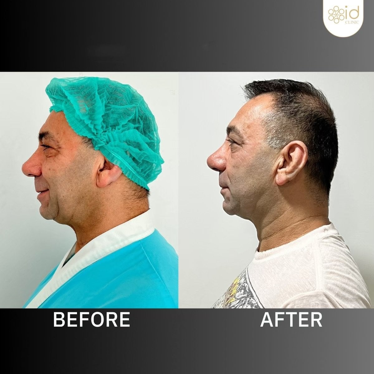 نتائج قبل وبعد تجميل طرف الأنف في ID Clinic Bangkok، تحسين شكل الأنف الجانبي