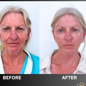 Before and after facelift results at ID Clinic Bangkok, visible facial rejuvenation and tightening