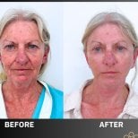 Before and after facelift results at ID Clinic Bangkok, visible facial rejuvenation and tightening