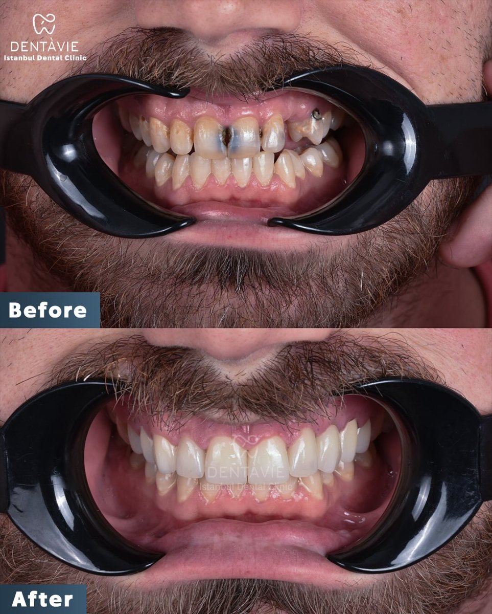 Resultado antes y después de implantes dentales All-on-6 en Dentavie Istanbul Dental Clinic, sonrisa restaurada