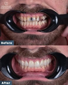 Before and after All-on-6 dental implants result at Dentavie Istanbul Dental Clinic, smile restored