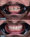 Before and after All-on-6 dental implants result at Dentavie Istanbul Dental Clinic, smile restored