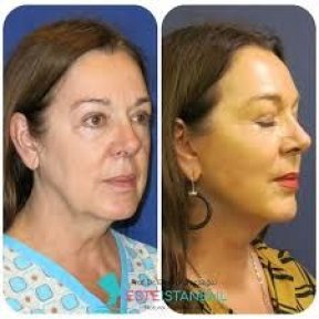 Facelift before and after results at Memorial Ataşehir Hospital, visible facial rejuvenation