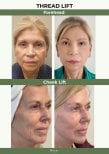 Результати до і після ниткового ліфтингу чола та щік у клініці Plenary Wellness