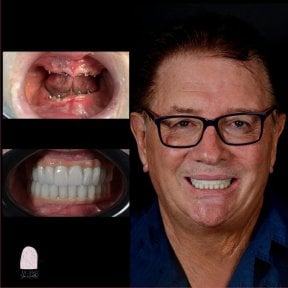 Before and after dental implant results at Dr. MED – restored smile and full teeth replacement