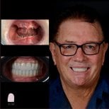 Before and after dental implant results at Dr. MED – restored smile and full teeth replacement