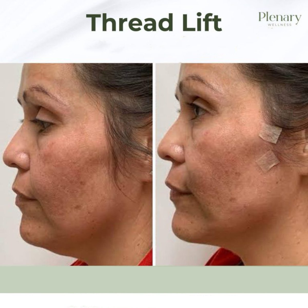 Результаты до и после нитевого лифтинга в Plenary Wellness, улучшение контура лица