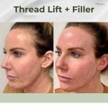 Résultats avant/après lifting par fils et fillers chez Plenary Wellness, amélioration du visage