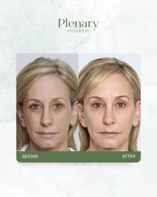 Antes y después de inyección de rellenos en Plenary Wellness, resultado visible facial