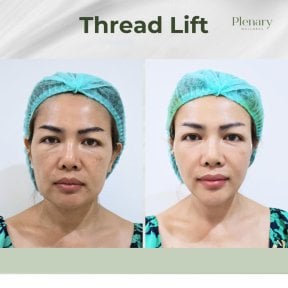 Before and after thread lift results at Plenary Wellness – facial contour and skin tightening