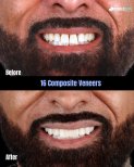 Vorher-nachher-Ergebnisse von 16 Komposit-Veneers bei SmileBox Dental Clinic - Thonglor, Sukhumvit