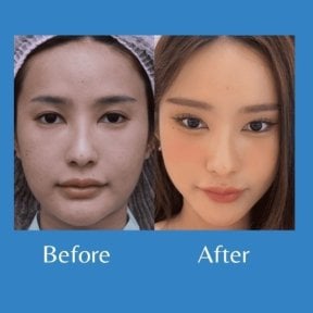 Before and after brow lift results at ID Clinic Bangkok, enhanced eyebrow and eye area
