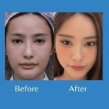 Before and after brow lift results at ID Clinic Bangkok, enhanced eyebrow and eye area
