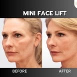 Before and after mini face lift results at ID Clinic Bangkok – visible facial rejuvenation