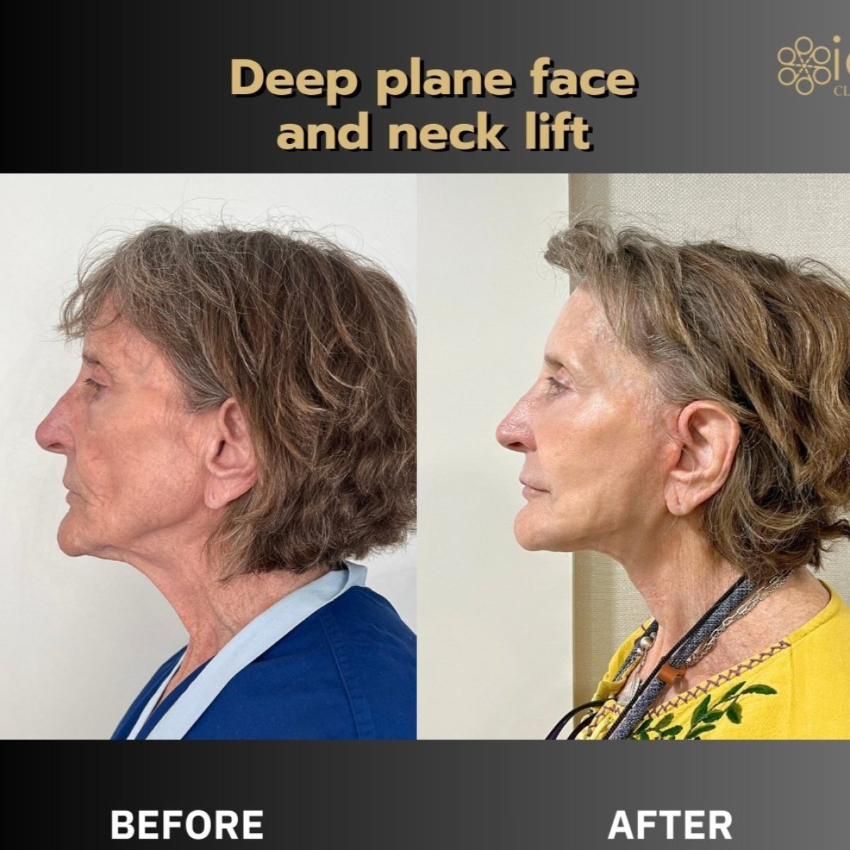 Resultados antes y después de lifting facial y de cuello profundo en ID Clinic Bangkok