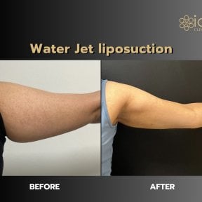Before and after Body Jet liposuction results on arms at ID Clinic Bangkok, improved contour