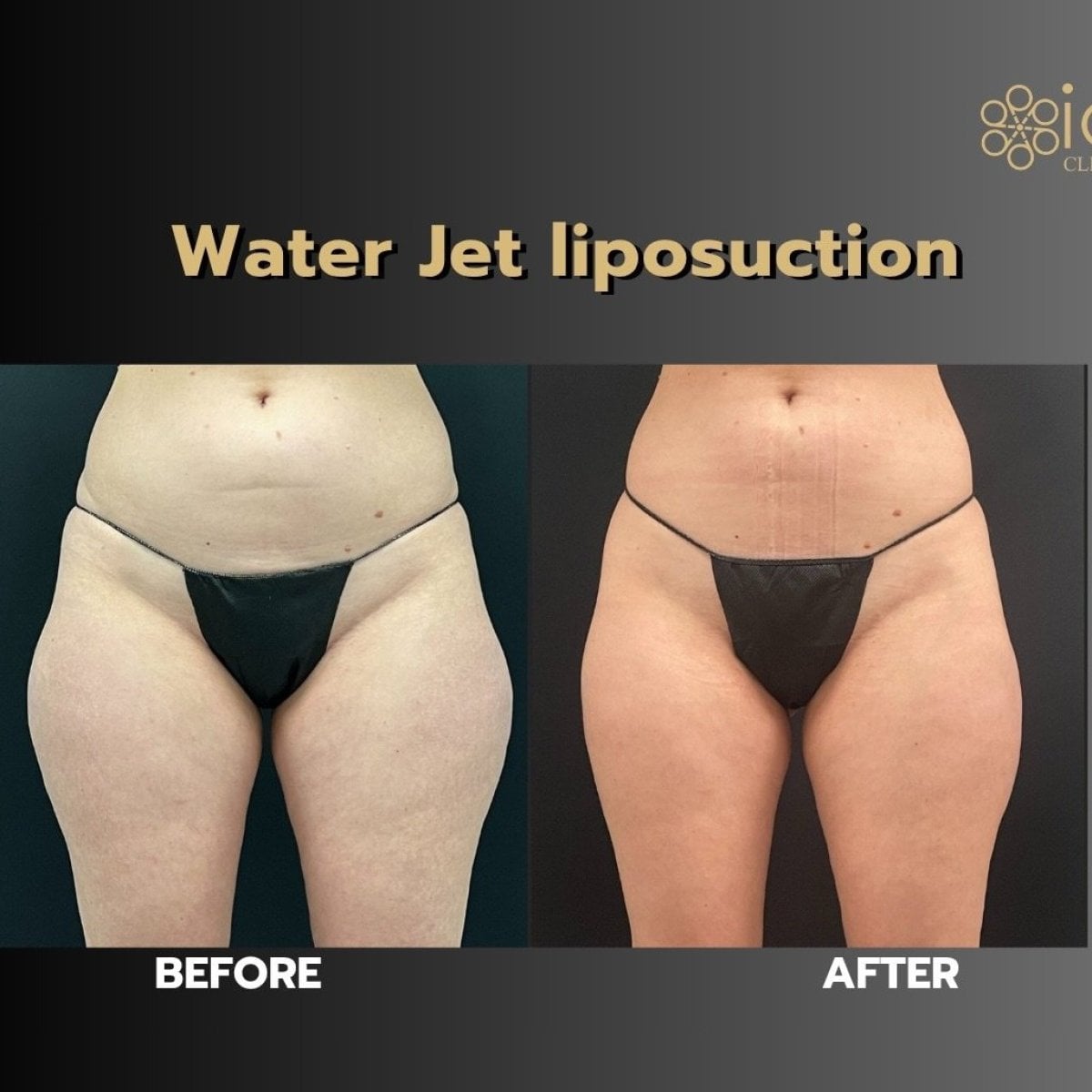 نتائج شفط الدهون Body Jet قبل وبعد في ID Clinic Bangkok مع تحسين شكل الجسم
