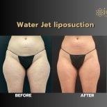 Before and after Body Jet liposuction results at ID Clinic Bangkok, improved body contour