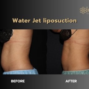 Before and after Body Jet liposuction results at ID Clinic Bangkok, visible waist contouring