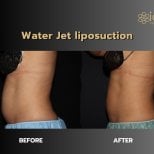 Before and after Body Jet liposuction results at ID Clinic Bangkok, visible waist contouring