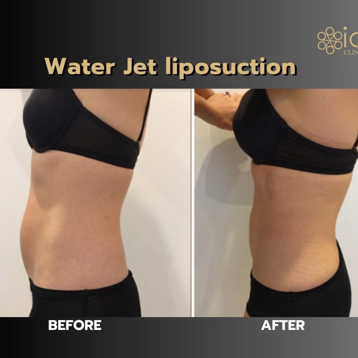 نتائج قبل وبعد شفط الدهون Body Jet في ID Clinic Bangkok، تحسين شكل البطن