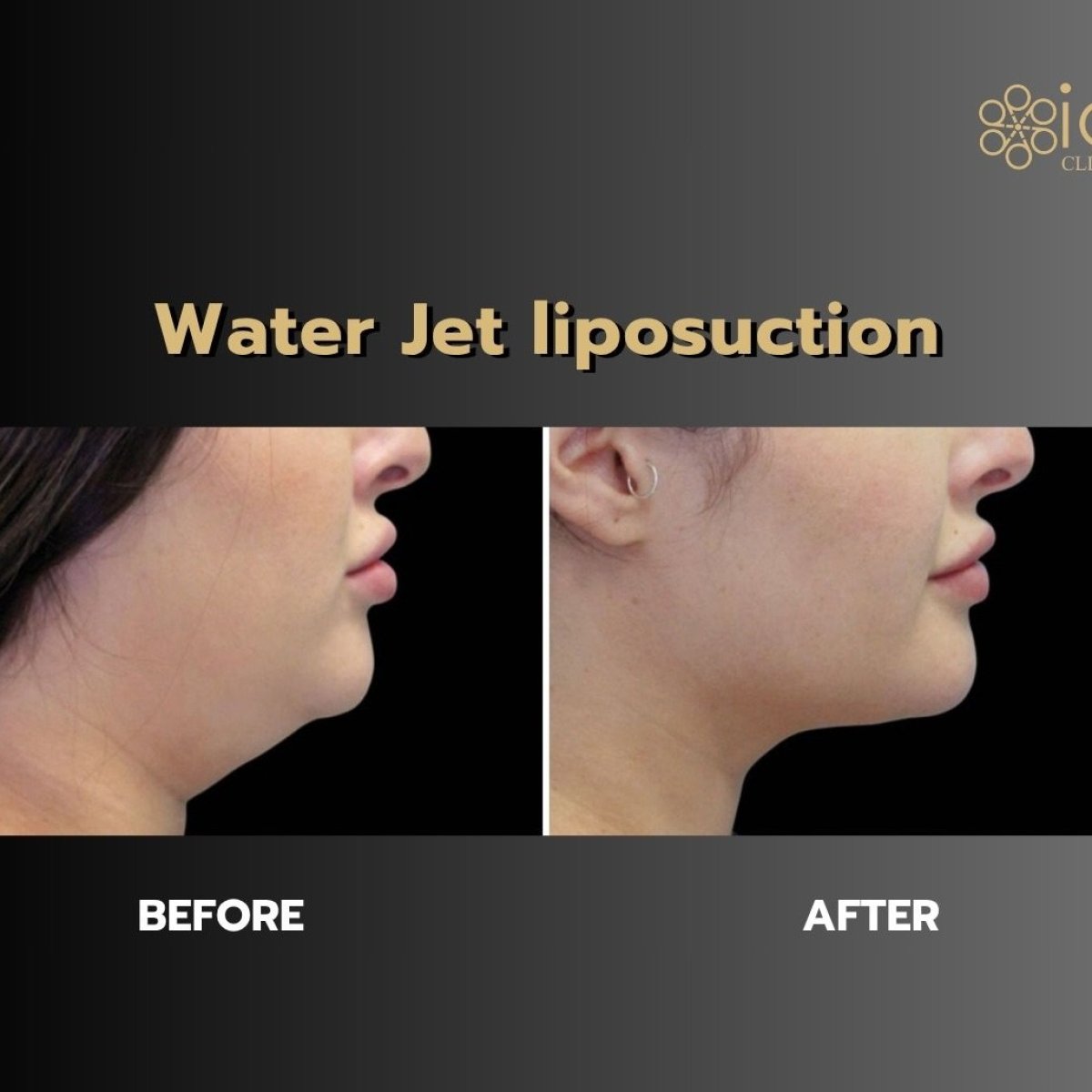 قبل وبعد شفط الدهون Body Jet في ID Clinic Bangkok، نتيجة تحديد الذقن المزدوج