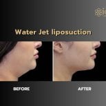 Before and after Body Jet liposuction at ID Clinic Bangkok, double chin contouring result