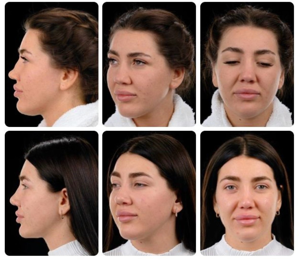 Результати ринопластики до і після в Yurchenko Plastic Surgery Team Kyiv, корекція носа