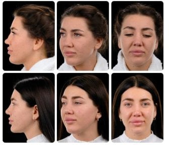 Результати ринопластики до і після в Yurchenko Plastic Surgery Team Kyiv, корекція носа