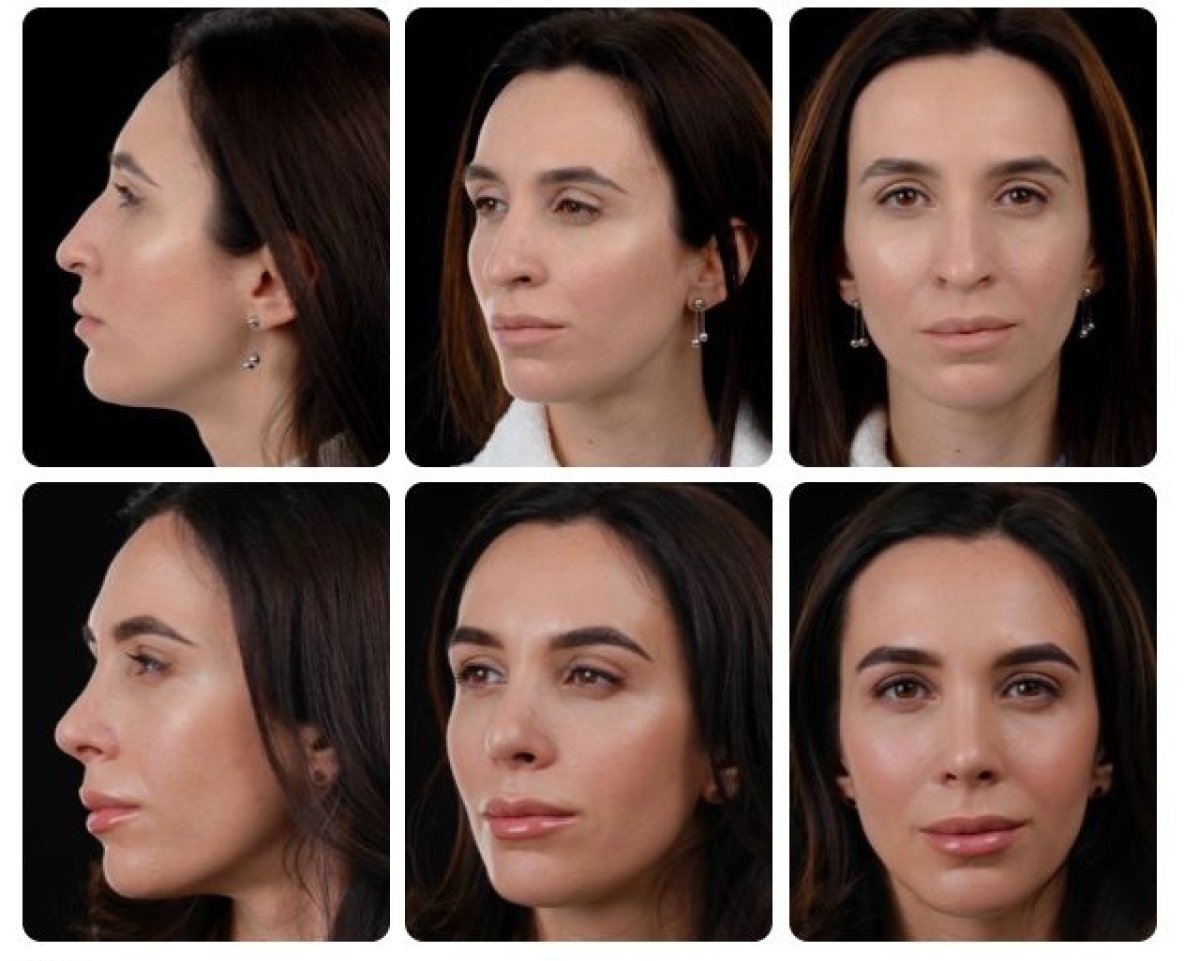 Результати ринопластики до і після в Yurchenko Plastic Surgery Team Kyiv, корекція носа