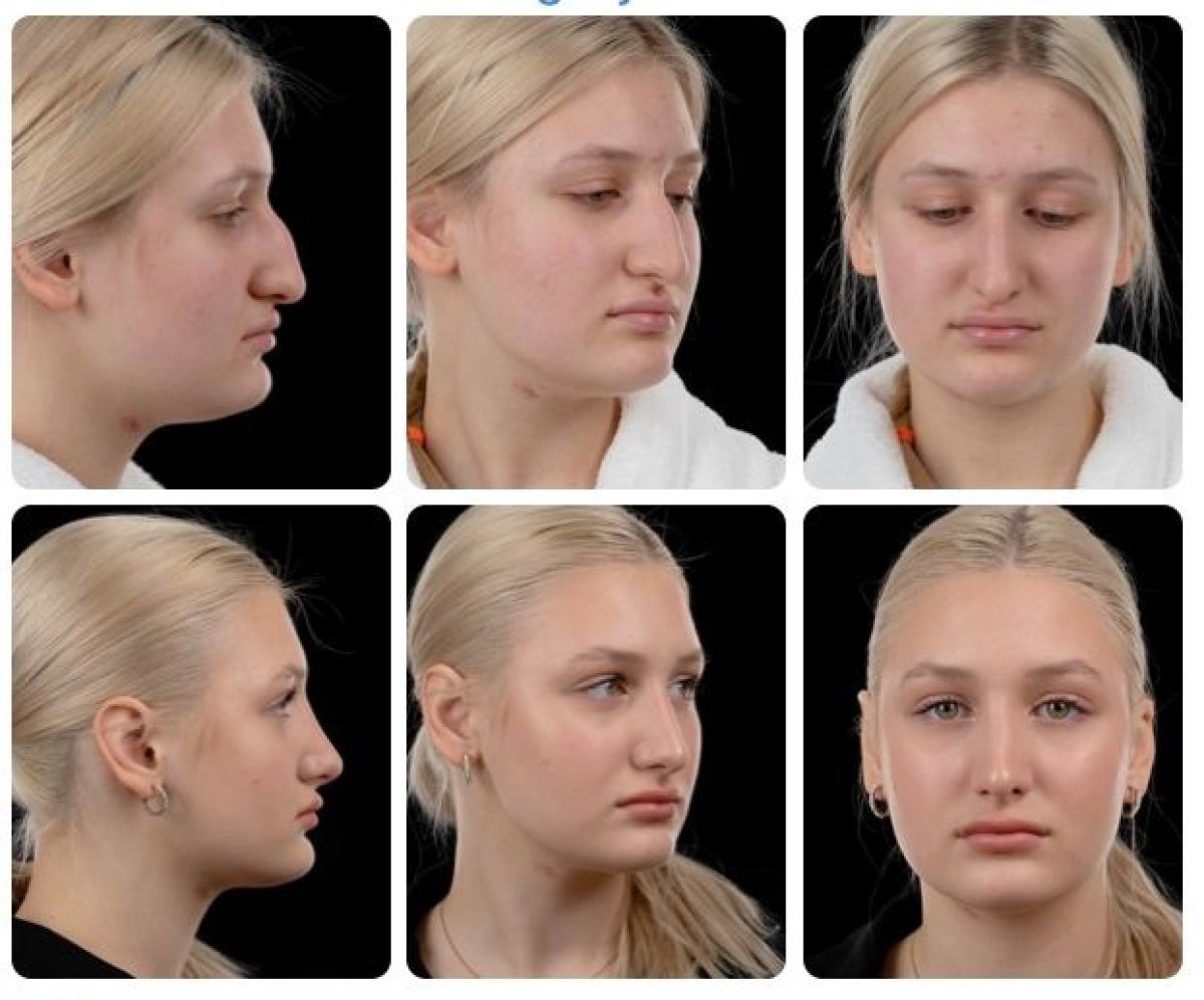 Результати ринопластики до і після в Yurchenko Plastic Surgery Team Kyiv, корекція носа
