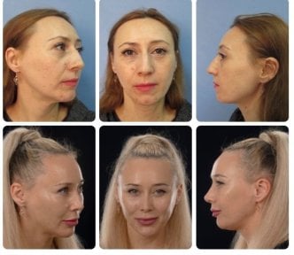 Результати ринопластики до і після в Yurchenko Plastic Surgery Team Kyiv, корекція носа