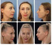 Результати ринопластики до і після в Yurchenko Plastic Surgery Team Kyiv, корекція носа