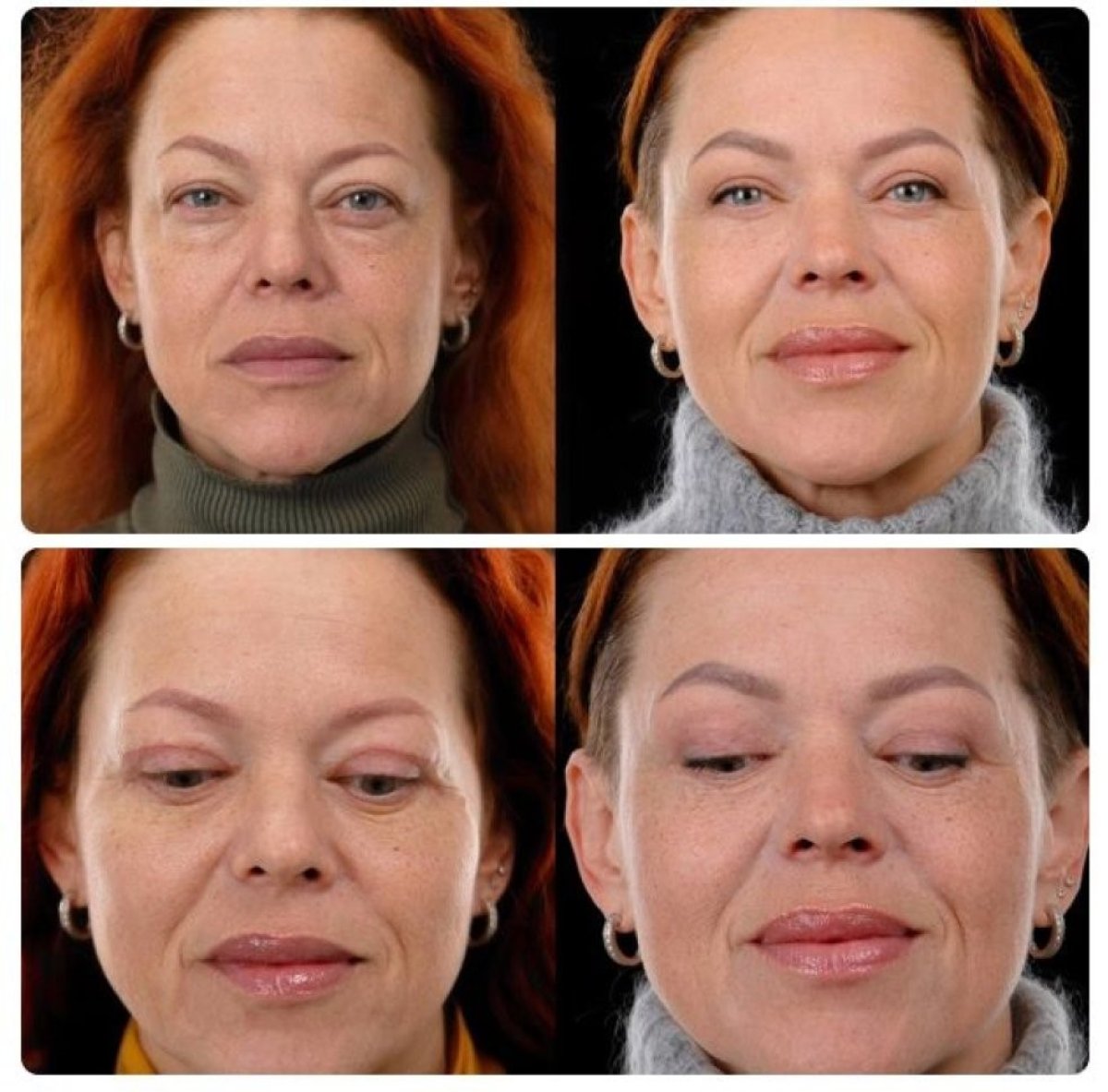 Resultados de lifting facial antes y después en Yurchenko Plastic Surgery Team Kyiv, rejuvenecimiento
