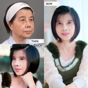 Before and after neck lift results at Dr. Chen Surgery Hospital International Center