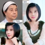 Before and after neck lift results at Dr. Chen Surgery Hospital International Center