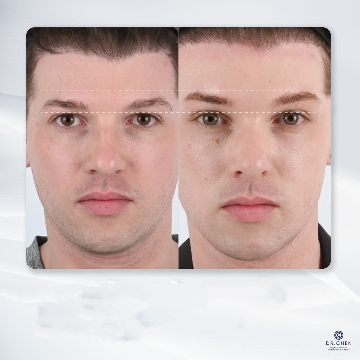 Resultado antes y después de lifting con hilos de ácido hialurónico en Dr. Chen Surgery Hospital