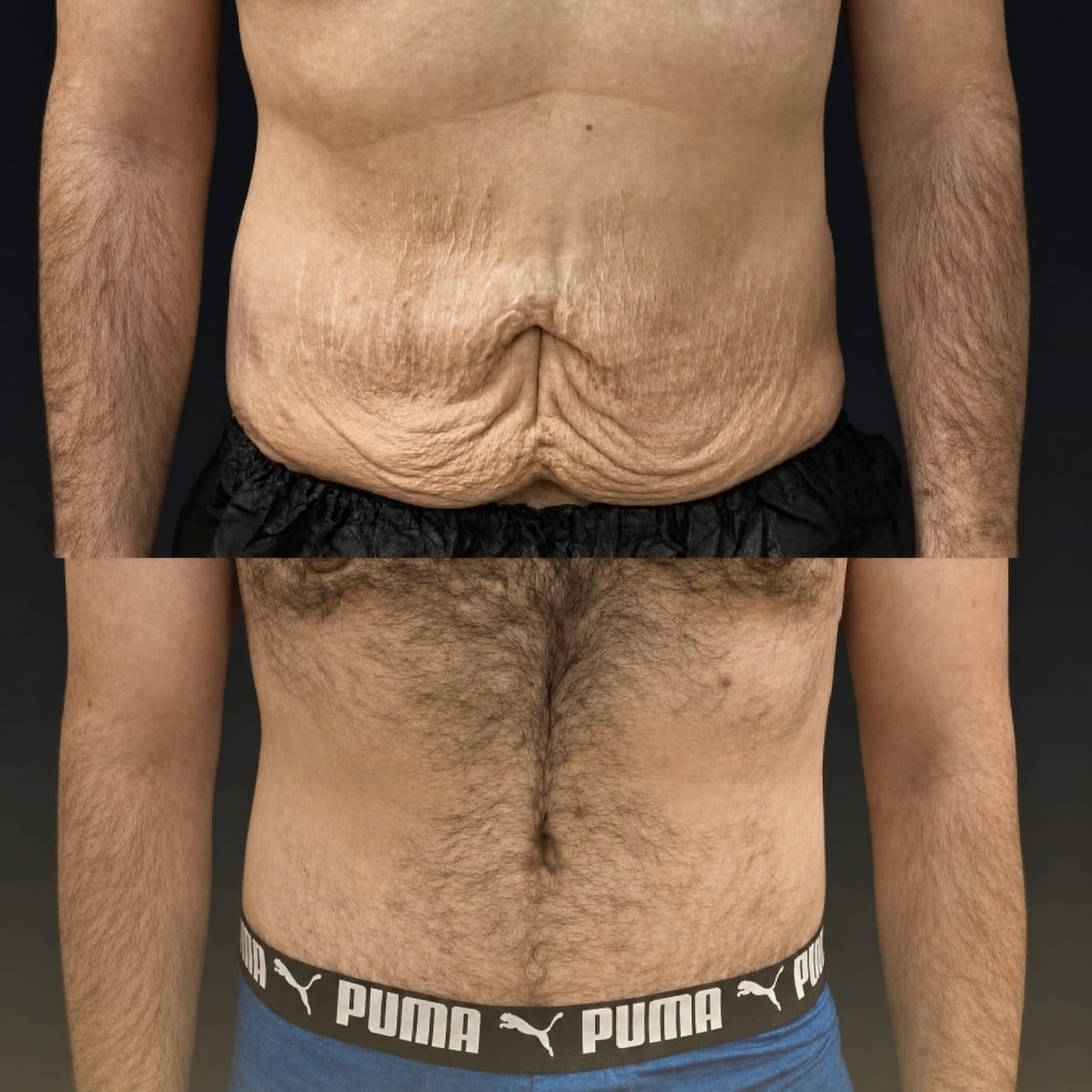 Resultados de abdominoplastia y liposucción antes y después en Memorial Şişli Hospital, abdomen plano