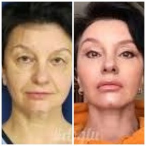 Facelift before and after results at Memorial Ataşehir Hospital, visible facial rejuvenation