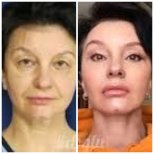 Facelift before and after results at Memorial Ataşehir Hospital, visible facial rejuvenation