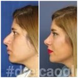 Before and after rhinoplasty results at Memorial Ataşehir Hospital, nose reshaping procedure