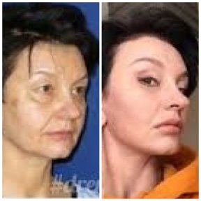 Facelift before and after results at Memorial Ataşehir Hospital, visible facial rejuvenation